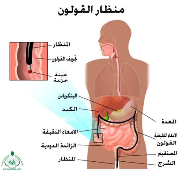 ���� Crohn`s Disease